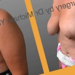 The Non-Surgical Breast Lift Mastopexy and Its Limitations