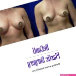 Fat Transfer Breast Augmentation: Natural Implant-Free Option