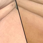 Monsplasty FUPA Reduction in Florida