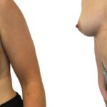 Teardrop vs Round Implants