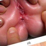 Clinical Differentiation between a Normal Anus Anterior Anus Congenital Anal Stenosis and Perineal Fistula: Definitions and ConsequencesThe ARM-Net Consortium Consensus
