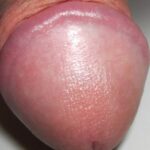 Glans penis